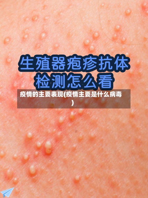 疫情的主要表现(疫情主要是什么病毒)-第3张图片