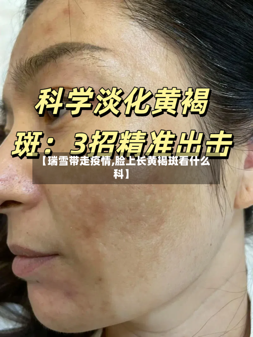 【瑞雪带走疫情,脸上长黄褐斑看什么科】-第2张图片