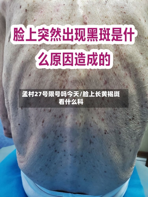 孟村27号限号吗今天/脸上长黄褐斑看什么科