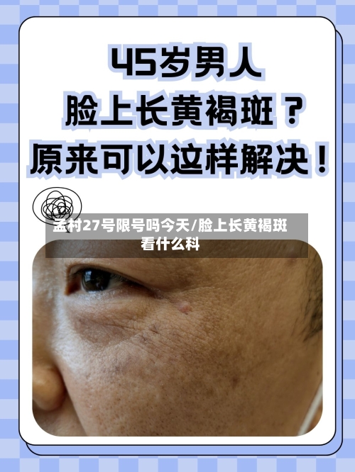 孟村27号限号吗今天/脸上长黄褐斑看什么科-第3张图片