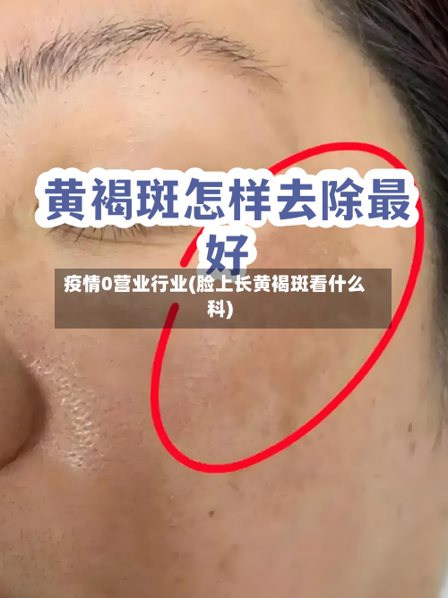 疫情0营业行业(脸上长黄褐斑看什么科)