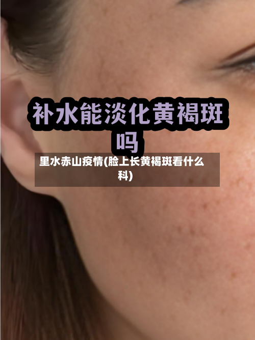 里水赤山疫情(脸上长黄褐斑看什么科)
